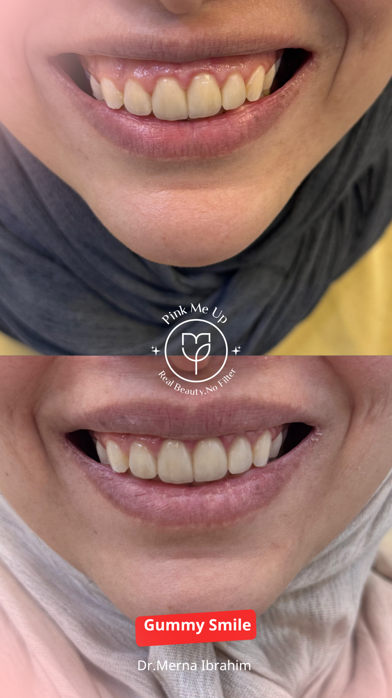 Botox for a gummy smile